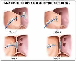 Device closure of congenitalbirth defects (ASD/PDA)
