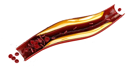Cholesterol treatment